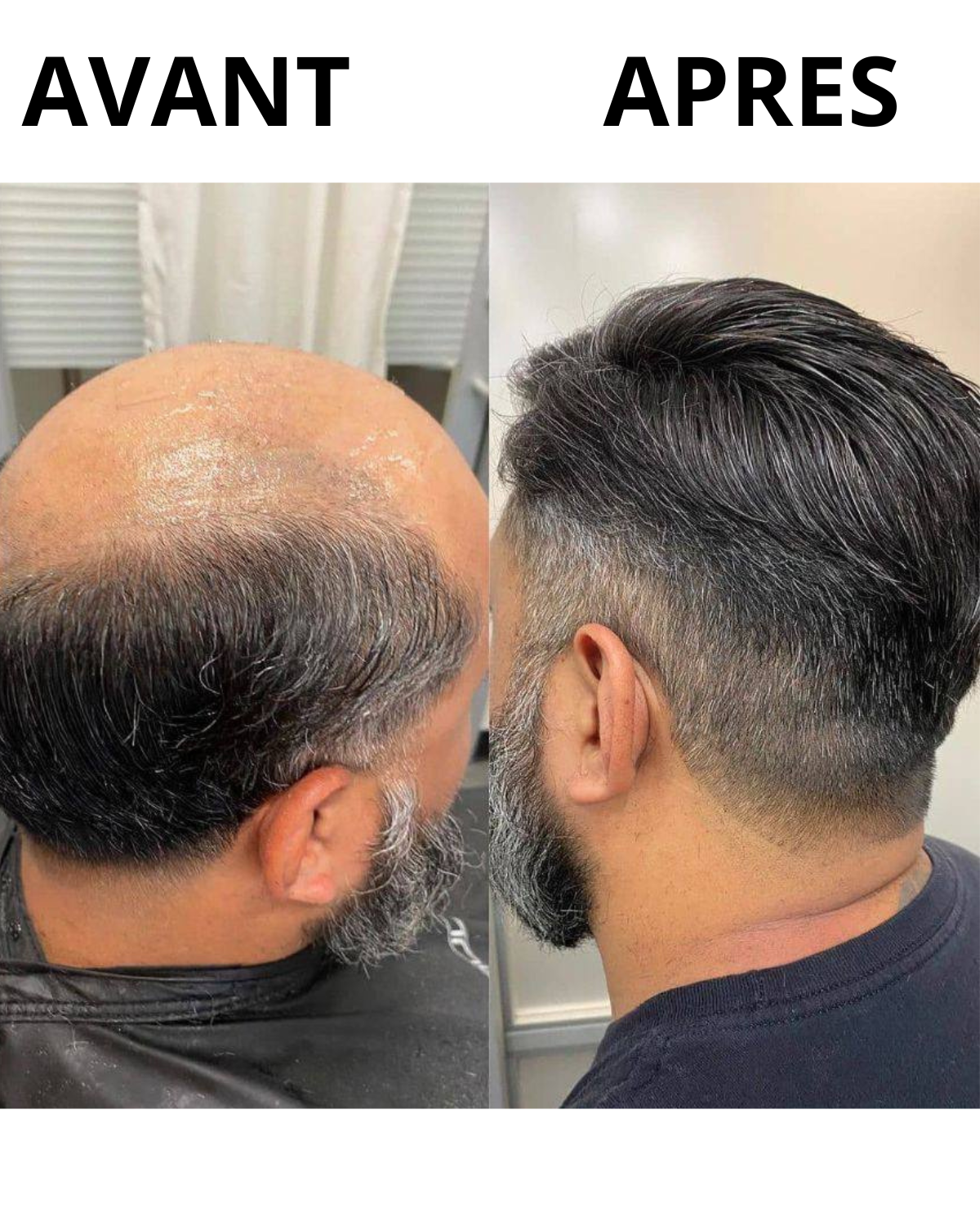 𝐅𝐢𝐛𝐫𝐞 𝐂𝐚𝐩𝐢𝐥𝐥𝐚𝐢𝐫𝐞 4 𝒆𝒏 1 💇‍♂️